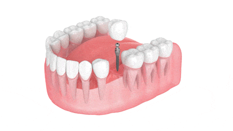 Implantes Dentales en Montville, NJ