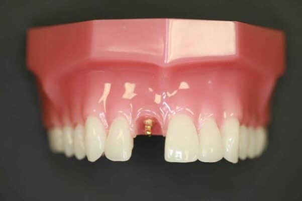 Mini Implantes Dentales en Montville, NJ - Ferrari Dental (2)