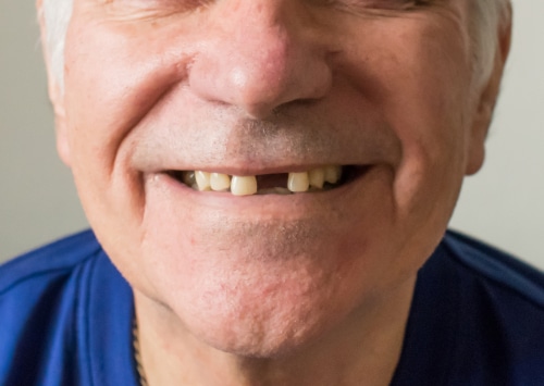 ¿Le faltan dientes? Los mini implantes dentales son la solución más asequible.