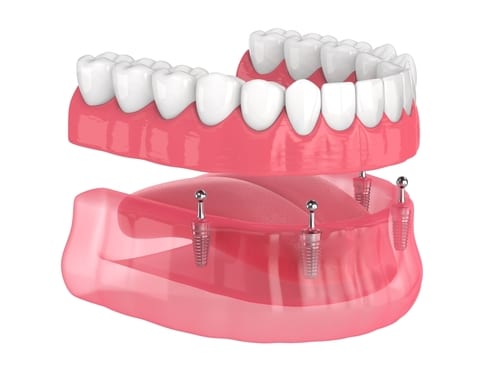 Snap-On Dentures - A Game-Changer in Denture Replacement