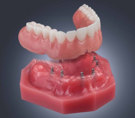 Dentaduras postizas sobre implantes El futuro de la restauración dental en Nueva Jersey