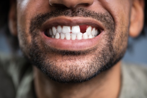 Tooth Replacement Options in Montville, NJ | Mini Dental Implants