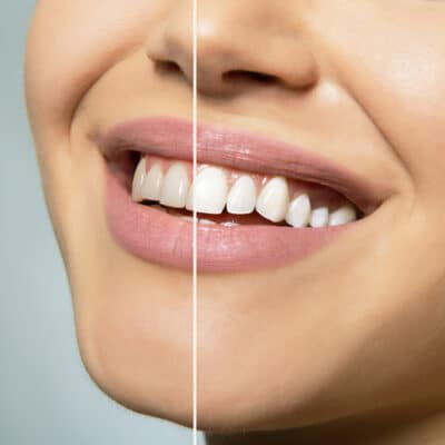 Teeth Bleaching in Parsippany NJ | Teeth Whitening | Ferrari Dental