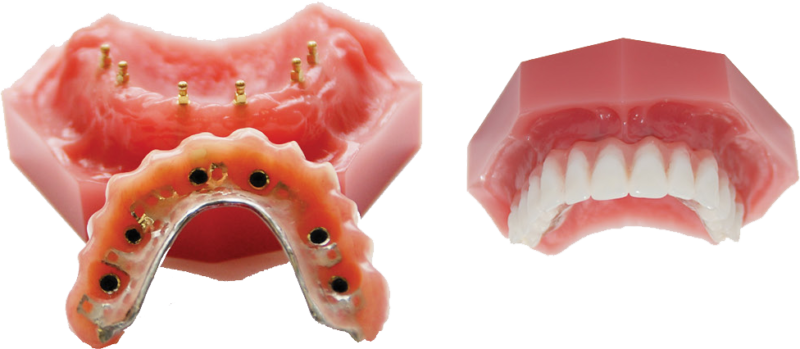 Dentaduras postizas en Morris County | Mini Implantes | Ferrari Dental
